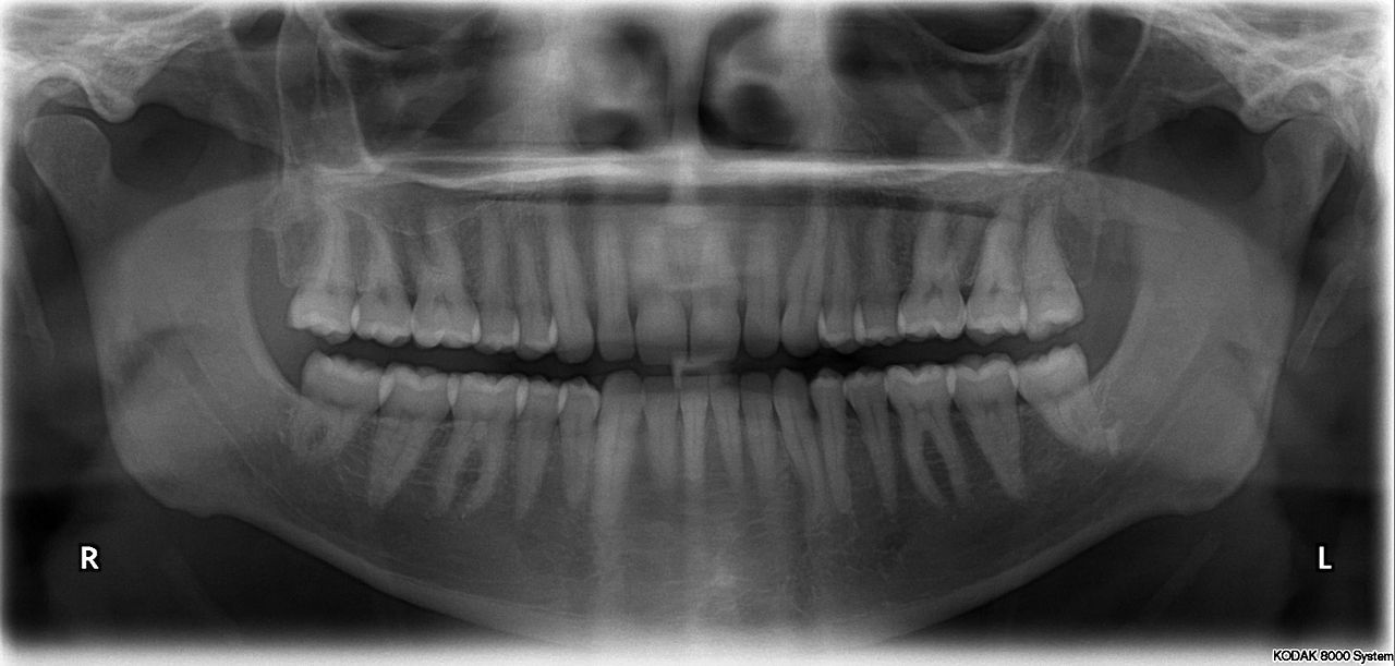 University Of Iceland May Participate In Controversial Dental Age Determination Testing