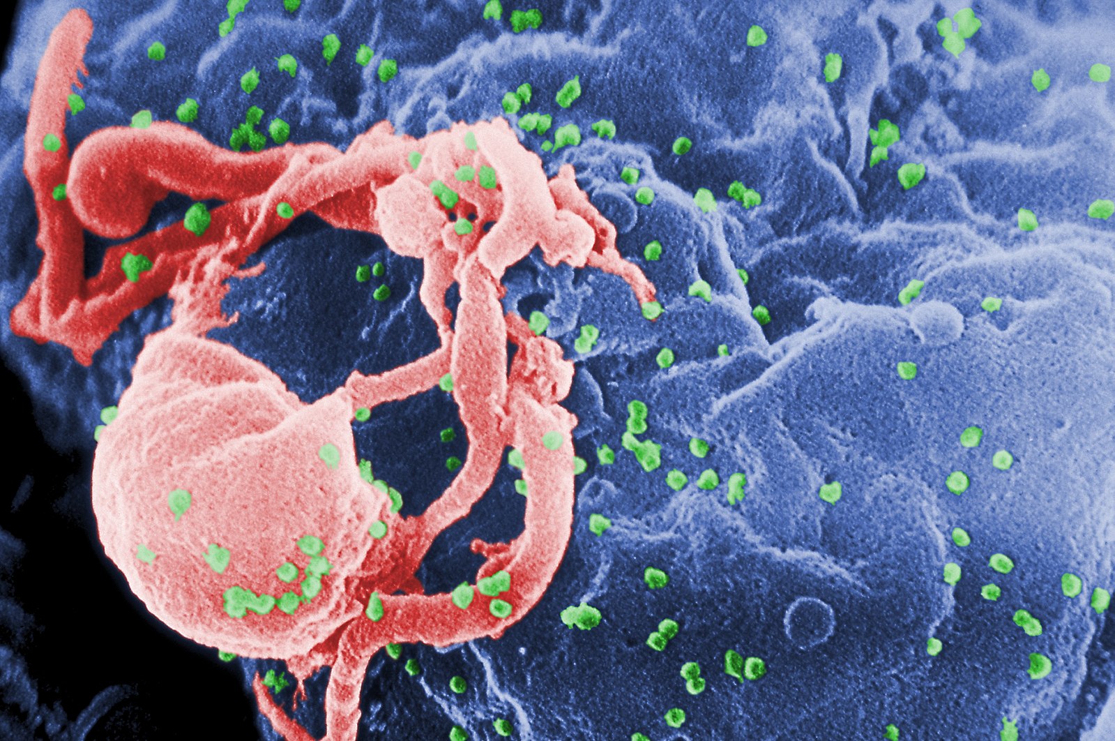 Icelandic Woman Sues Man Over Non-Disclosure Of HIV