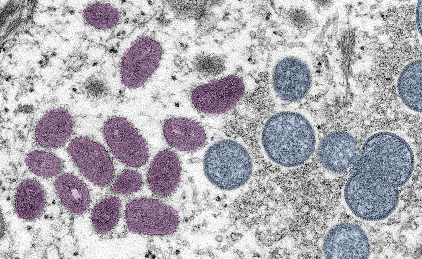 Mpox Cases In Iceland Declining