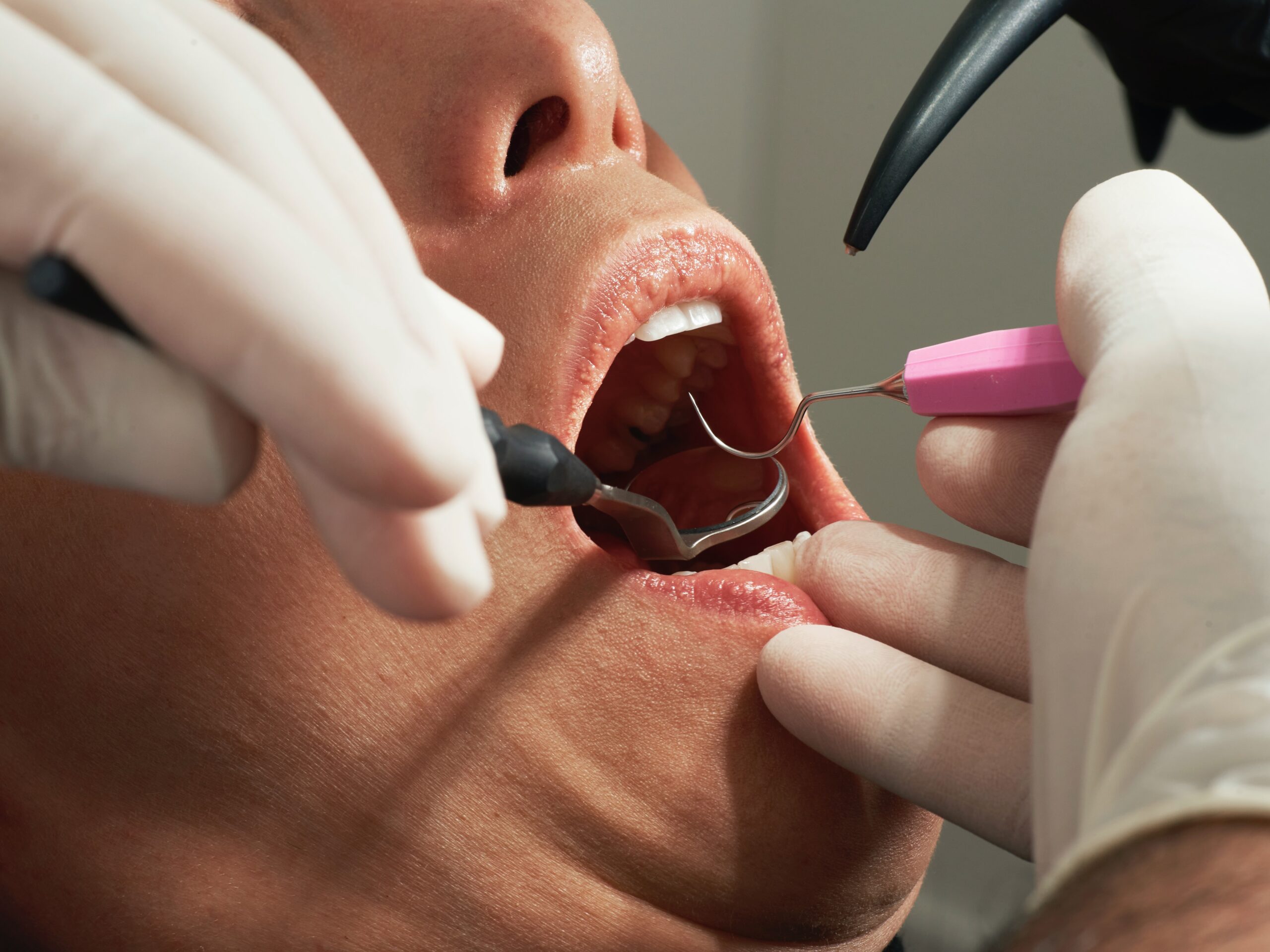 Icelandic Dentists Prescribe Antibiotics More Than Their Nordic Colleagues