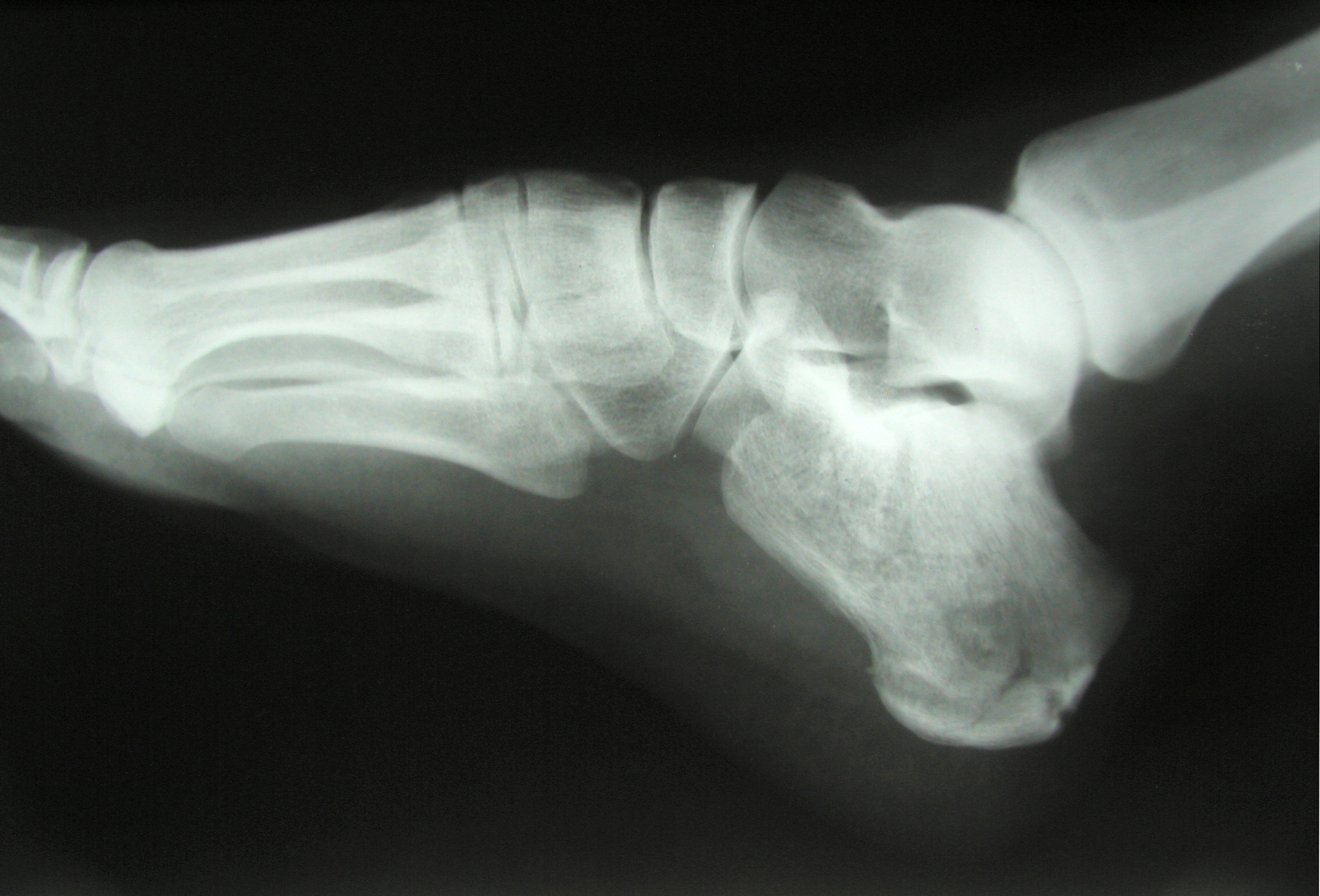 Lots Of Broken Bones On The Sidewalks
